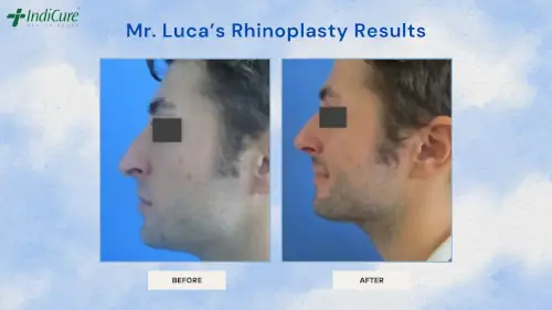 Mr. Luca's Rhinoplasty Results in India